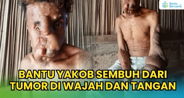 31 Tahun, Tumor Merenggut Wajah Yakob