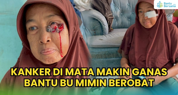 Kanker Di Mata Makin Ganas, Bantu Bu Mimin Berobat