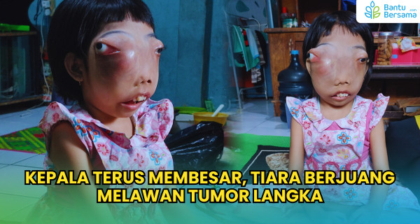 Kepala Terus Membesar, Tiara Berjuang Melawan Tumor Langka
