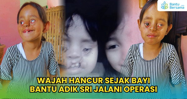 Wajah Hancur Sejak Bayi, Bantu Adik Sri Jalani Operasi