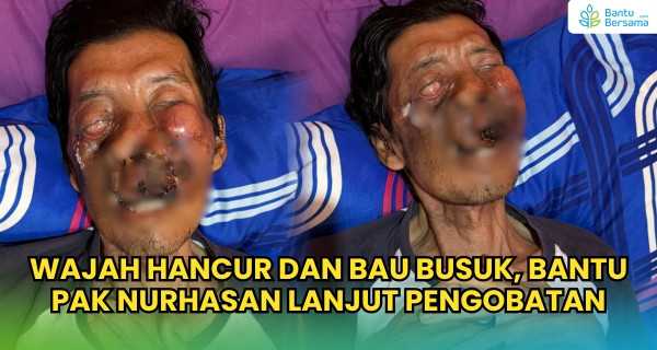 Wajah Hancur Dan Bau Busuk, Bantu Pak Nurhasan Lanjut Pengobatan