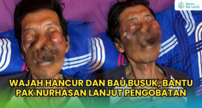 Wajah Hancur Dan Bau Busuk, Bantu Pak Nurhasan Lanjut Pengobatan